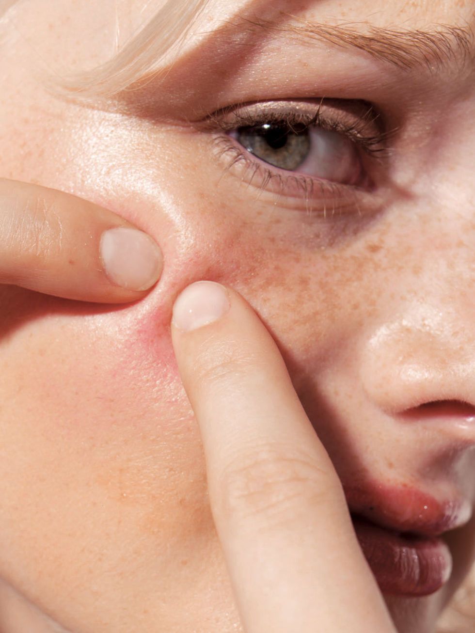 Acne Basic