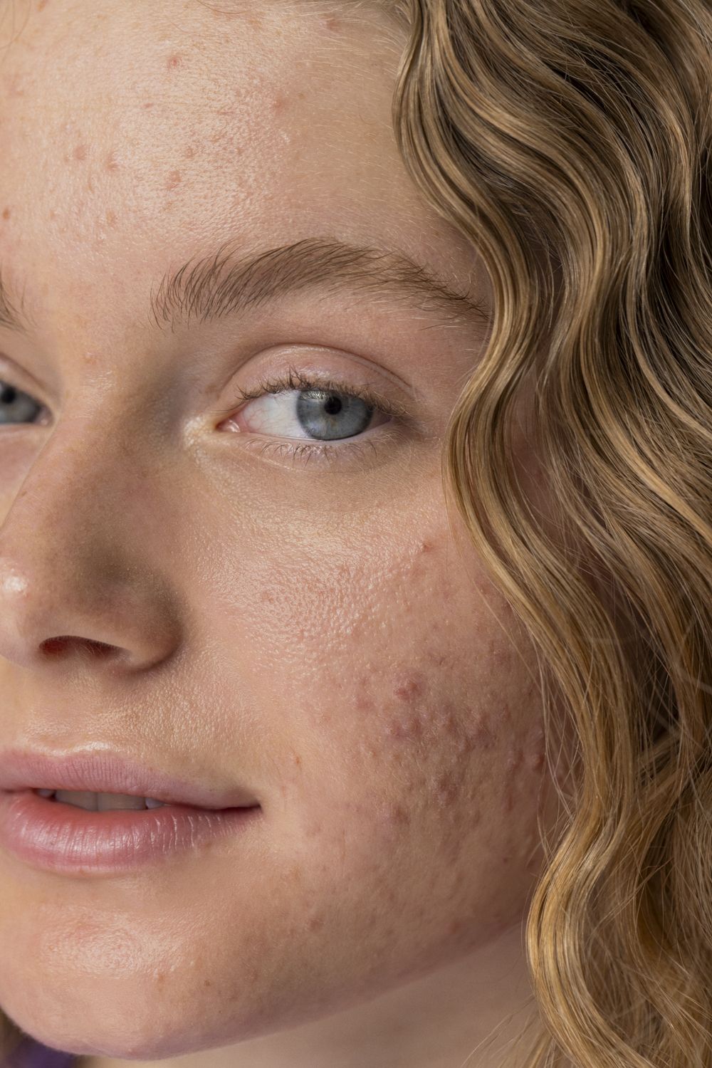 Acne Advanced